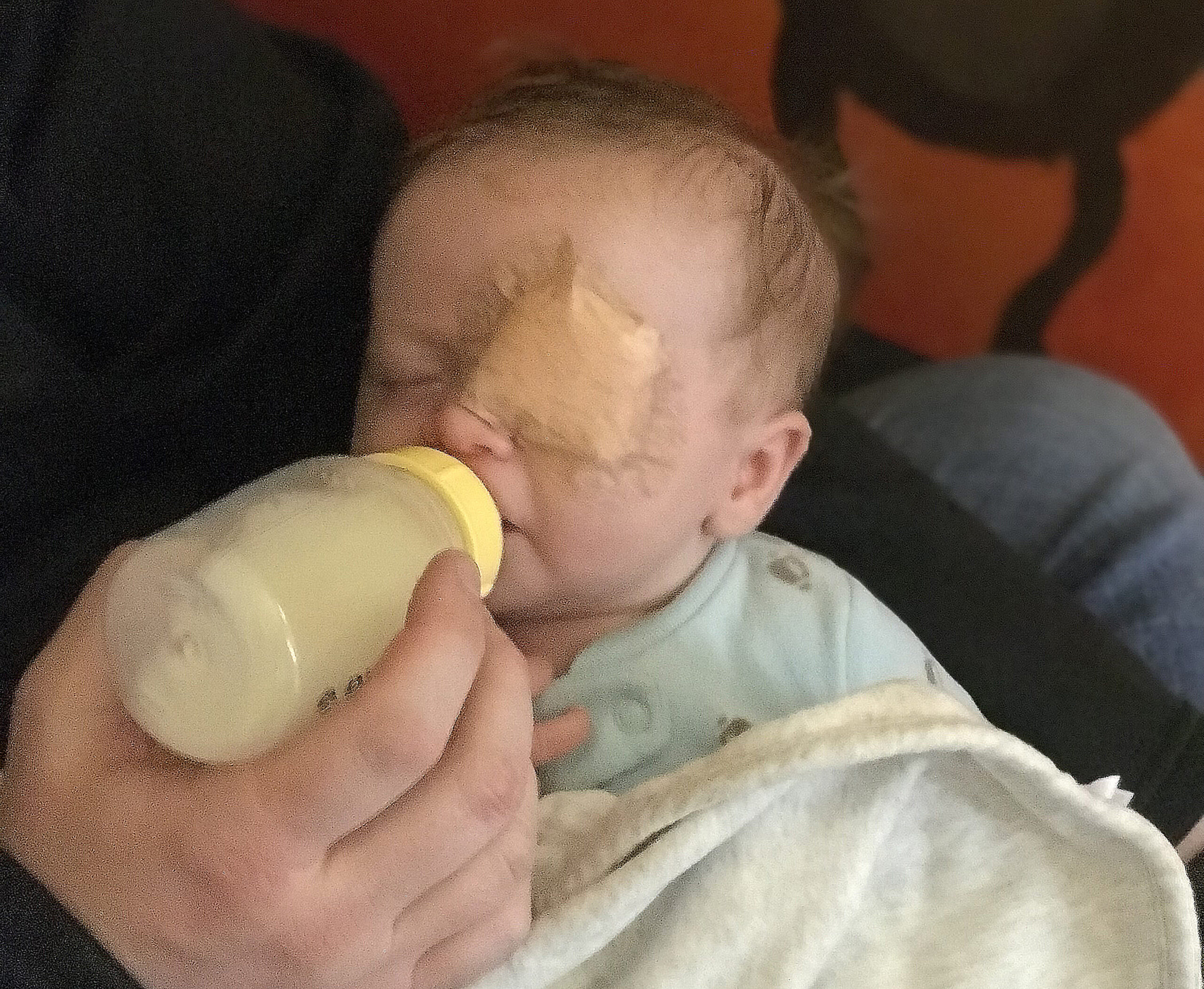 An infant with an eyepatch drinking from a bottle