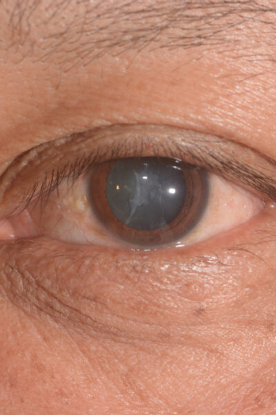close up of the cataract during eye examination,