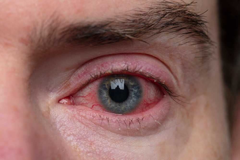 Close-up of a bloodshot eye