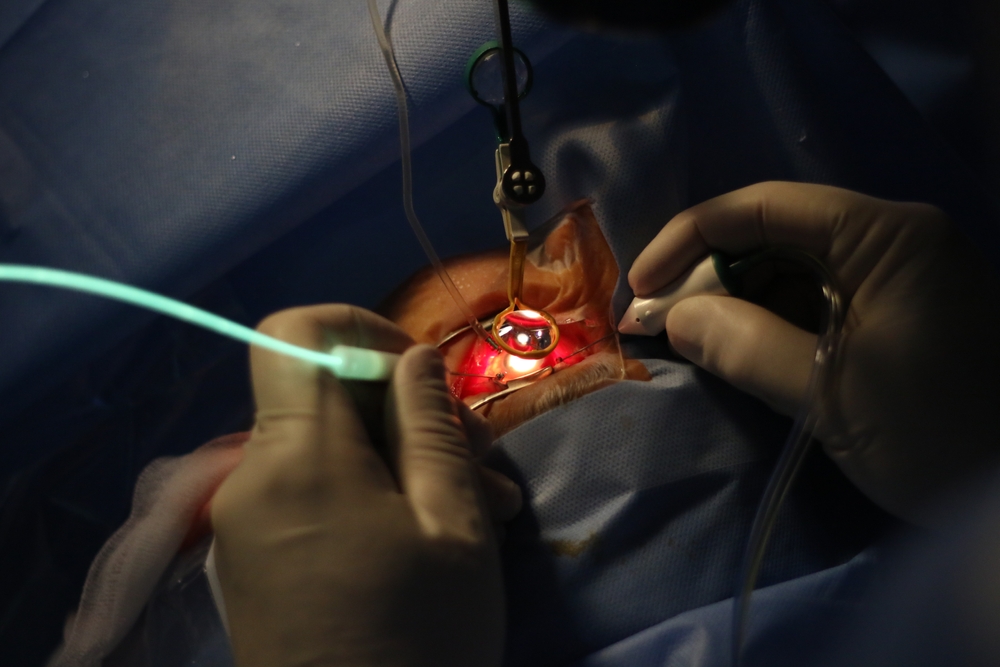 photo showing vitrectomy surgery.